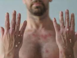 Monkey Pox Alert: कर्नाटक में मंकीपॉक्स का पहला मामला सामने, स्वास्थ्य विभाग ने जारी की चेतावनी