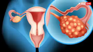 हर साल हजारों महिलाओं की जान ले लेता है ये कैंसर, नहीं दिखते शुरुआती लक्षण – जानें ओवेरियन कैंसर के संकेत और बचाव