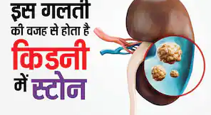 किडनी में पथरी होने के सबसे बड़े कारण और बचाव के उपाय