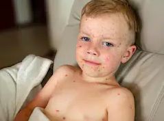 टेक्सास में खसरे का कहर: अमेरिका में दूसरी बच्चे की मौत, जानिए लक्षण और बचाव के उपाय